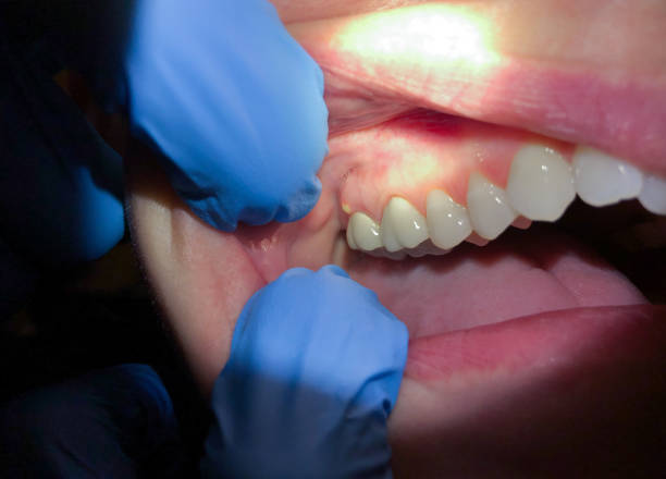 Best Emergency Root Canal Treatment in Penn Wynne, PA